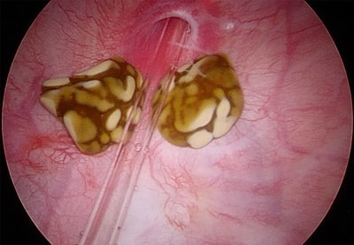 膀胱鏡で見た結石