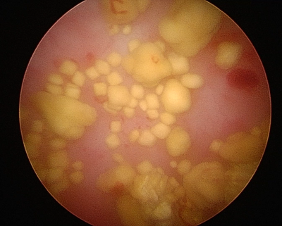 腹腔鏡で見た犬の膀胱結石